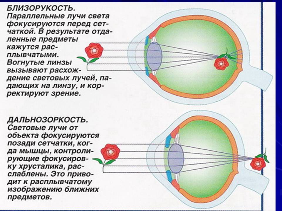 Перед сетчаткой расположена. Дальнозоркость и близорукость строение глаза. Анатомия глаза близорукость и дальнозоркость. Строение глаза человека близорукость. Глаз дальнозоркость и близорукость.