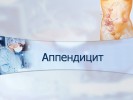 Аппендицит