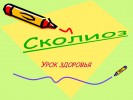 Сколиоз